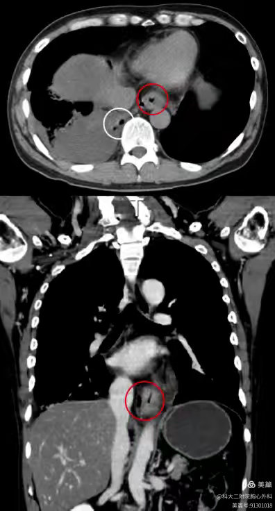 食管突遭「爆雷」,一场鱼汤引发的健康危机!医生紧急提醒毕业季聚餐风险