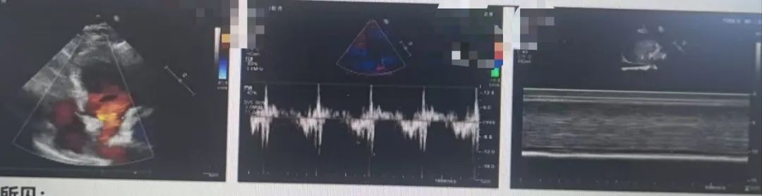 心脏瓣膜病+红斑狼疮+心脏感染，多病缠身医治陷困境，心脏中心迎难而上助其重获「心」生
