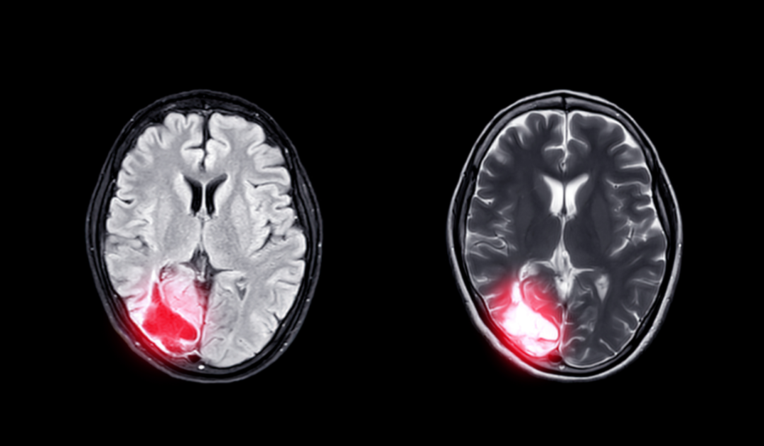 整天昏昏沉沉、乏力记忆力差？警惕脑供血不足！