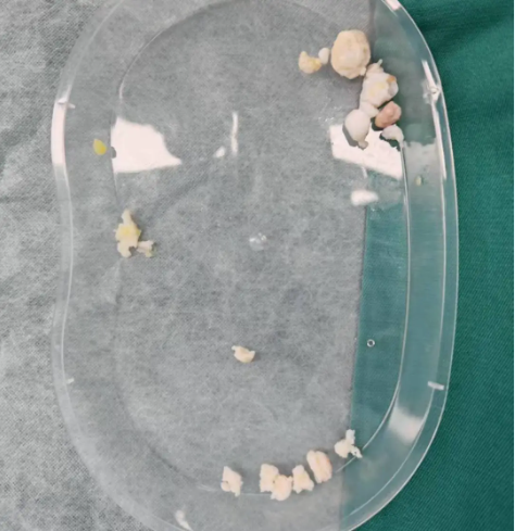 苏州明基医院骨科中心关节与运动医学科微创技术全覆盖：四大关节疑难杂症，「钥匙孔」内精准破解