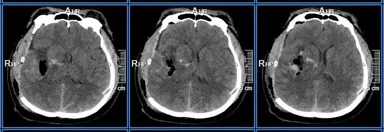 我院神经外二科上演「颅脑生死时速」,成功抢救突发昏迷患者