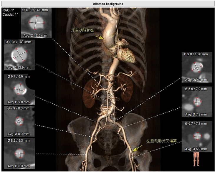 75 岁老人主动脉瓣畸形伴狭窄，血管还 「拐急弯」！医生用一根针，不开刀换「心门」