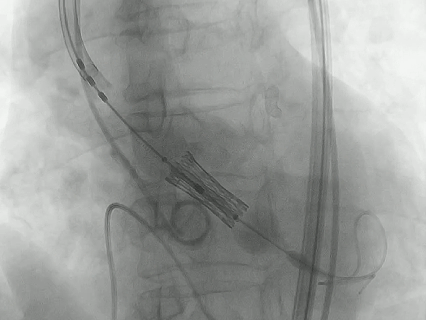 75 岁老人主动脉瓣畸形伴狭窄，血管还 「拐急弯」！医生用一根针，不开刀换「心门」