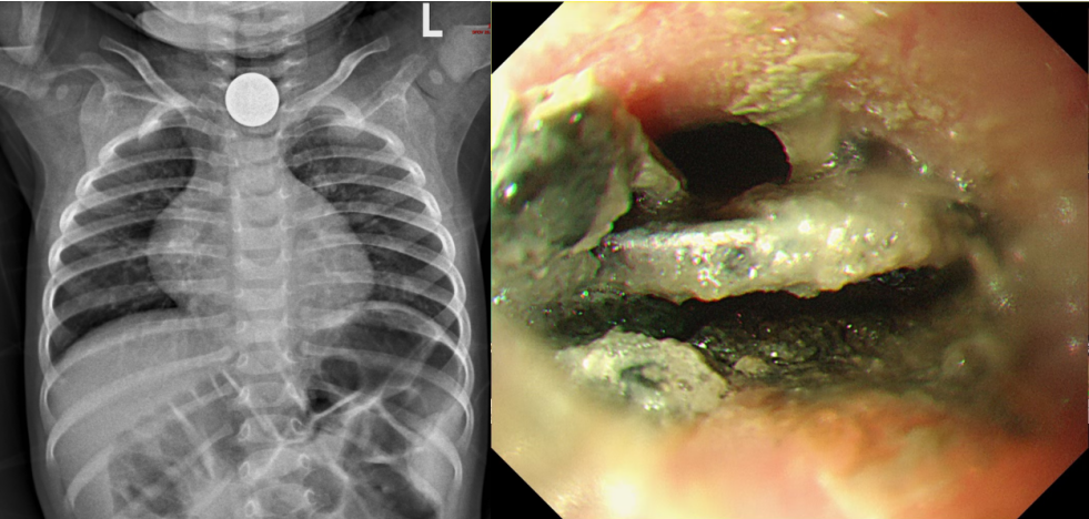 1-3 岁儿童成高危人群，这些「致命凶器」就在孩子身边