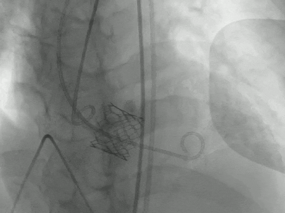 75 岁老人主动脉瓣畸形伴狭窄，血管还 「拐急弯」！医生用一根针，不开刀换「心门」