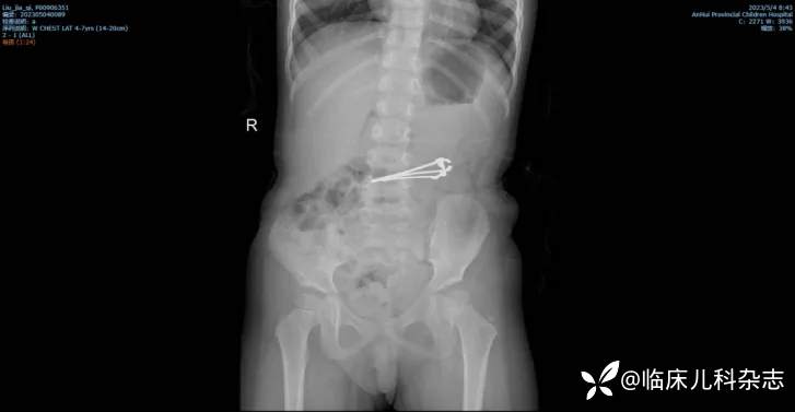 1-3 岁儿童成高危人群，这些「致命凶器」就在孩子身边