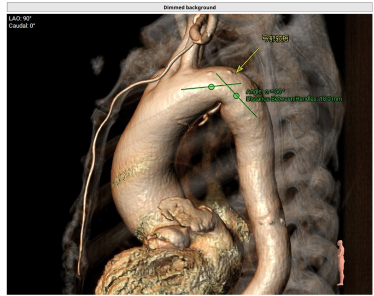 75 岁老人主动脉瓣畸形伴狭窄，血管还 「拐急弯」！医生用一根针，不开刀换「心门」
