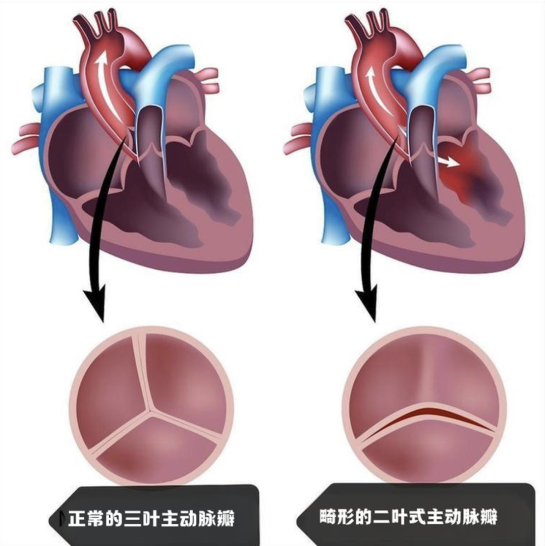 75 岁老人主动脉瓣畸形伴狭窄，血管还 「拐急弯」！医生用一根针，不开刀换「心门」