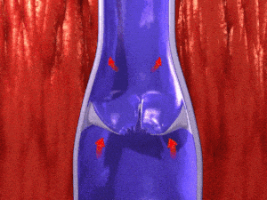 美国总统也中招？关于「慢性静脉功能不全」，你需要知道的都在这里！