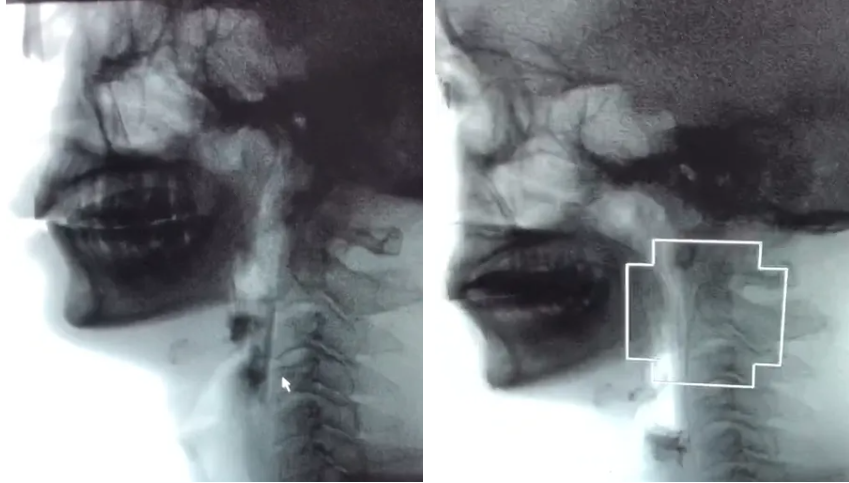 打破吞咽「困局」，重启美味「食」光——康复医学科「导管球囊扩张术」助力吞咽功能恢复