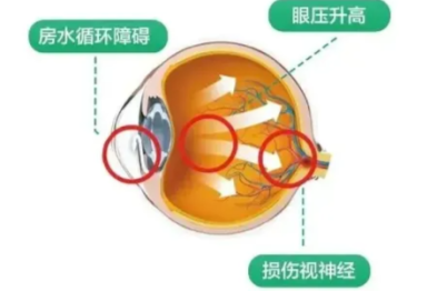 高度近视与眼压的双向关系