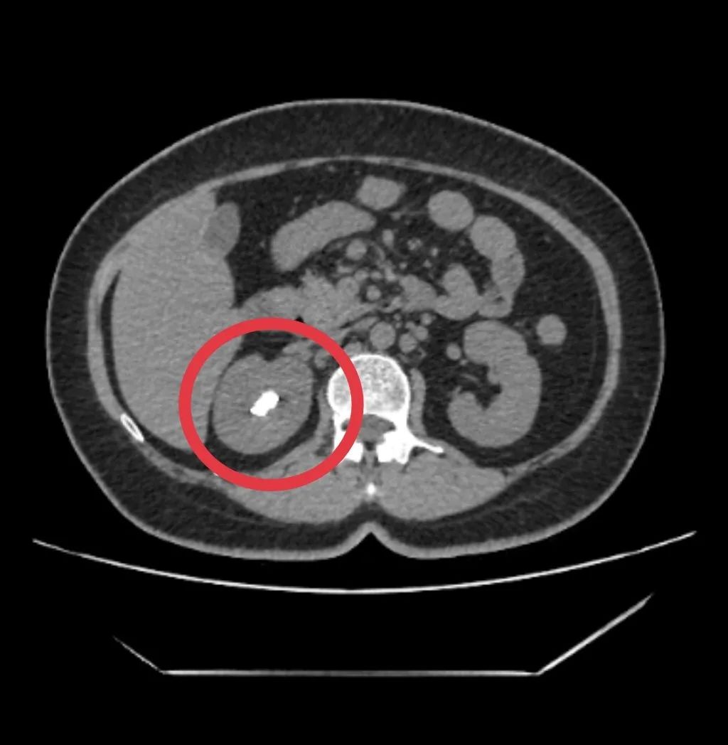 别大意!输尿管支架超期未取,结石长成棒槌模样