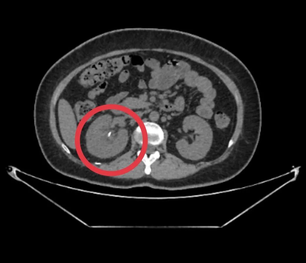 别大意!输尿管支架超期未取,结石长成棒槌模样