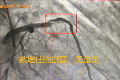 耳鼻喉科医生多问一句，救回心梗患者！心梗会「伪装」，你能识别吗？