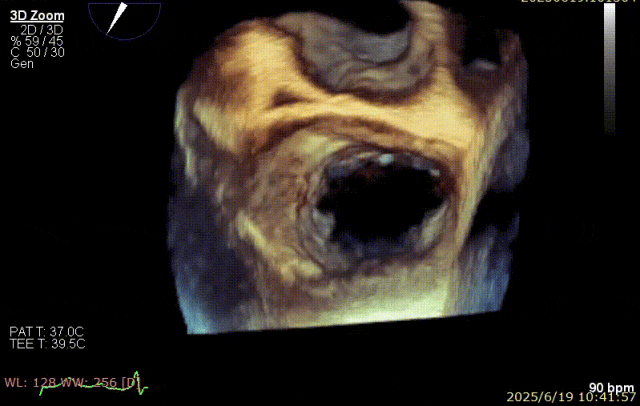 广西医科大一附院心胸外科团队成功完成广西首例经右胸小切开穿房间隔创新入路 TEER 手术