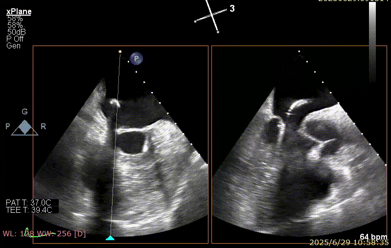 广西医科大一附院心胸外科团队成功完成广西首例经右胸小切开穿房间隔创新入路 TEER 手术