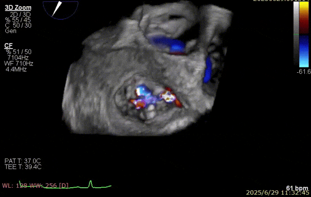 广西医科大一附院心胸外科团队成功完成广西首例经右胸小切开穿房间隔创新入路 TEER 手术