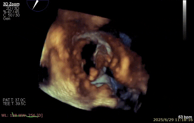 广西医科大一附院心胸外科团队成功完成广西首例经右胸小切开穿房间隔创新入路 TEER 手术