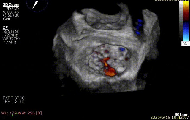 广西医科大一附院心胸外科团队成功完成广西首例经右胸小切开穿房间隔创新入路 TEER 手术