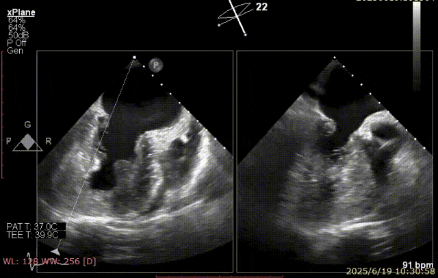 广西医科大一附院心胸外科团队成功完成广西首例经右胸小切开穿房间隔创新入路 TEER 手术