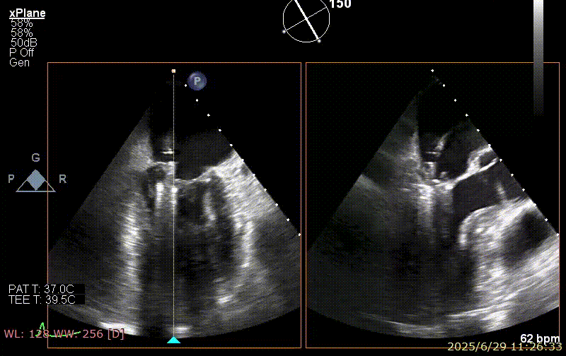 广西医科大一附院心胸外科团队成功完成广西首例经右胸小切开穿房间隔创新入路 TEER 手术
