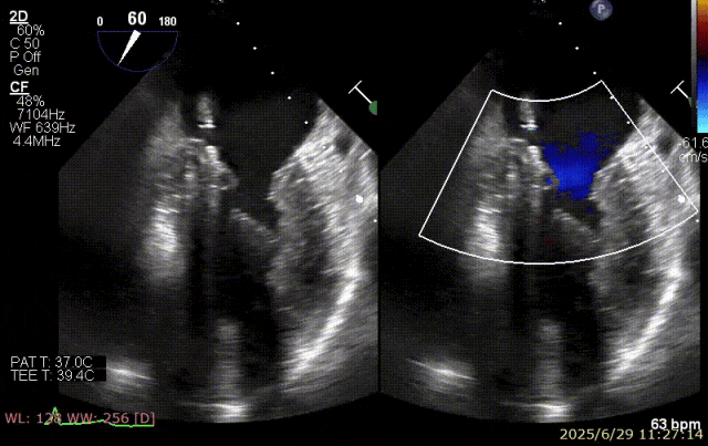 广西医科大一附院心胸外科团队成功完成广西首例经右胸小切开穿房间隔创新入路 TEER 手术