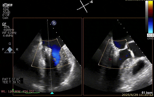广西医科大一附院心胸外科团队成功完成广西首例经右胸小切开穿房间隔创新入路 TEER 手术