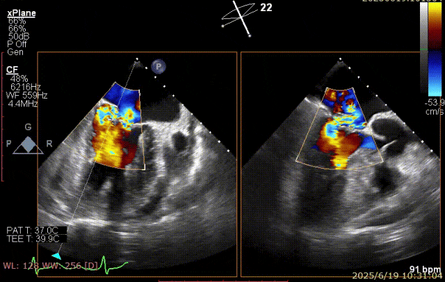 广西医科大一附院心胸外科团队成功完成广西首例经右胸小切开穿房间隔创新入路 TEER 手术