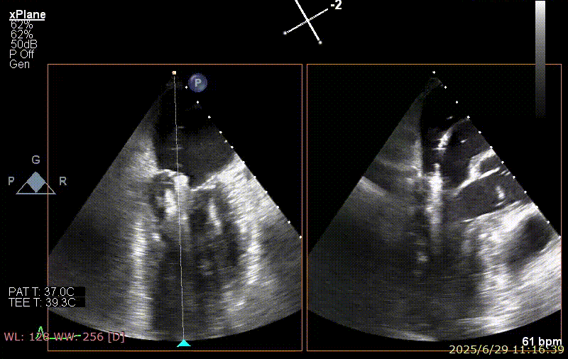 广西医科大一附院心胸外科团队成功完成广西首例经右胸小切开穿房间隔创新入路 TEER 手术