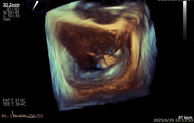 广西医科大一附院心胸外科团队成功完成广西首例经右胸小切开穿房间隔创新入路 TEER 手术