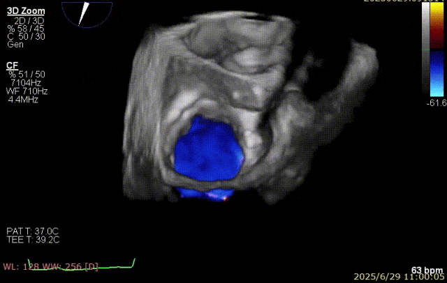 广西医科大一附院心胸外科团队成功完成广西首例经右胸小切开穿房间隔创新入路 TEER 手术
