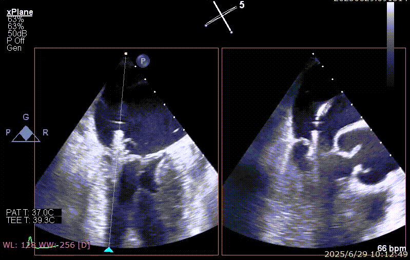 广西医科大一附院心胸外科团队成功完成广西首例经右胸小切开穿房间隔创新入路 TEER 手术