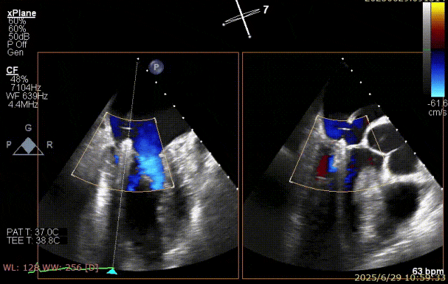 广西医科大一附院心胸外科团队成功完成广西首例经右胸小切开穿房间隔创新入路 TEER 手术