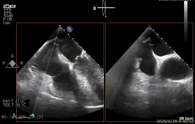 广西医科大一附院心胸外科团队成功完成广西首例经右胸小切开穿房间隔创新入路 TEER 手术