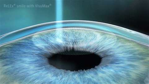 大学生暑期摘镜全攻略!