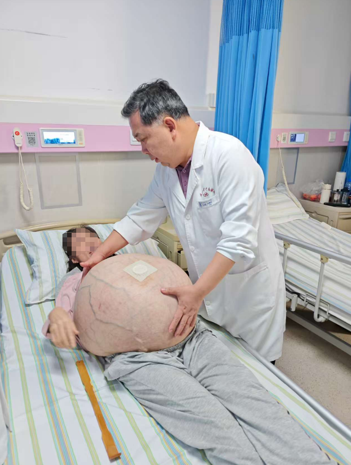 80 斤!武大中南医院多学科专家联手切除全球罕见巨瘤