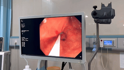 西安交大一附院东院区消化内科开展首例内镜下多环黏膜切除术