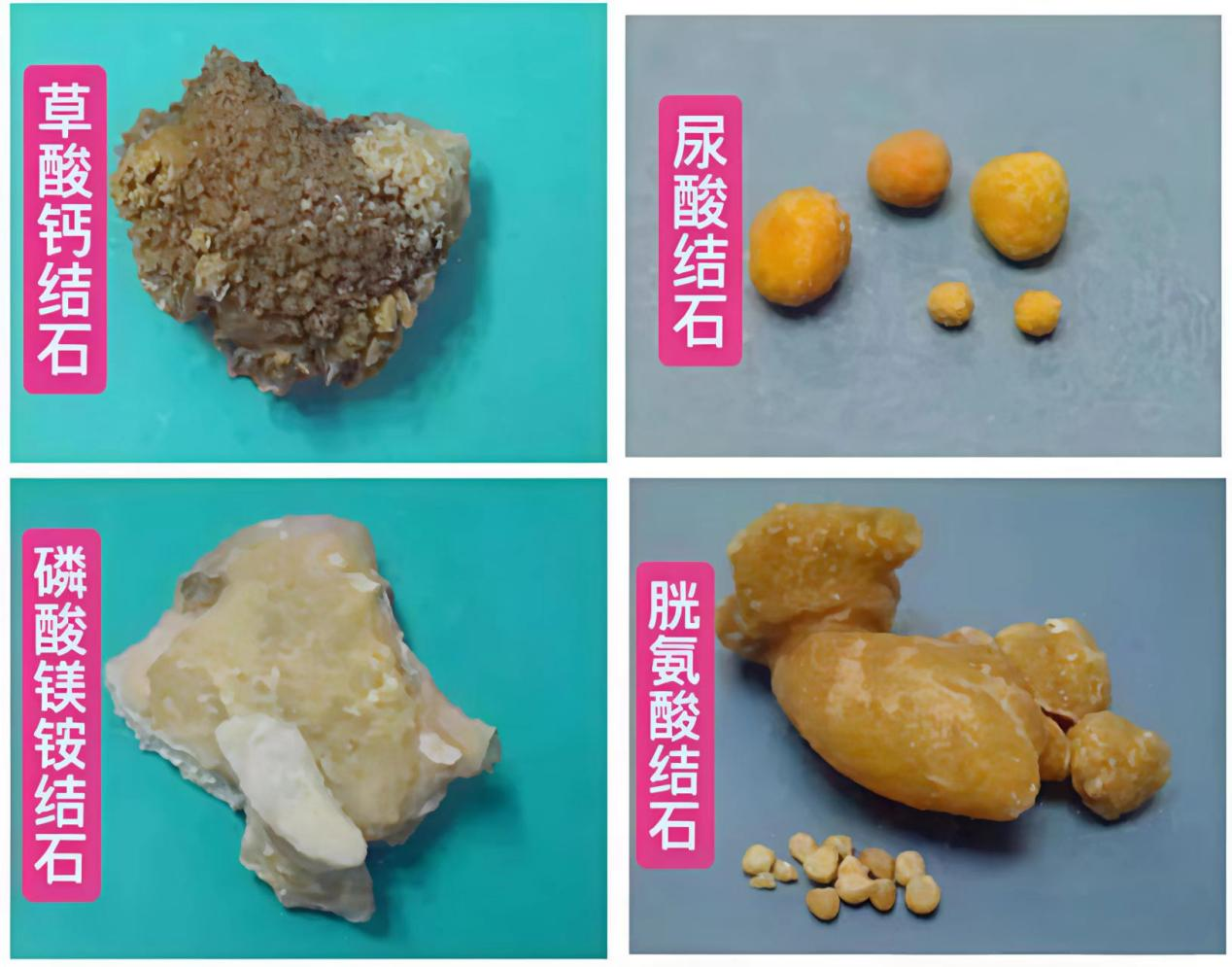 一方水土养一方结石? 结石成分藏玄机~