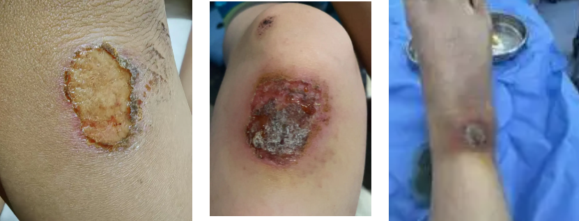 专家揭秘:伤口最怕的不是细菌,是你手里的那瓶...