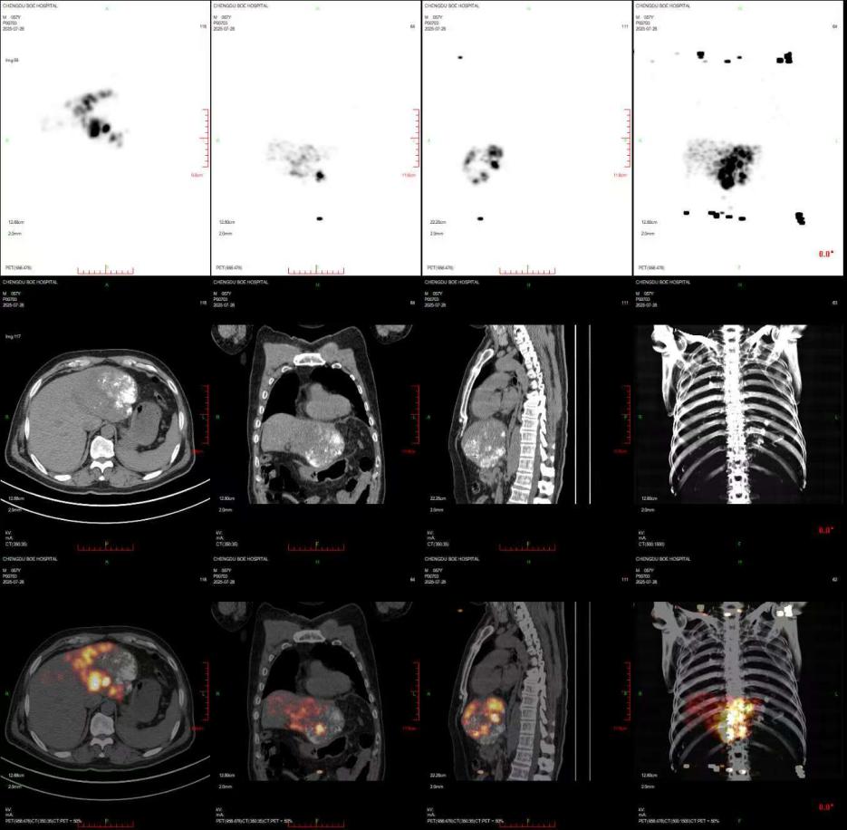 成都京东方医院成功开展钇 [90Y] 微球治疗肝脏恶性肿瘤手术