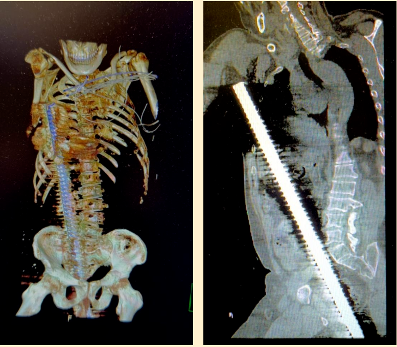 致命钢筋穿透胸腹,五小时生死竞速丨厘毫米级移除体内钢筋,团队协作再现生命奇迹!