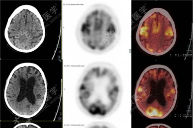 记忆神偷与脑内「拆弹专家」：当争议手术退场，影像诊断如何照亮阿尔茨海默迷雾