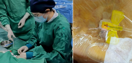 生命新「港」口！荆门市中心医院完成首例胸壁原位输液港置入