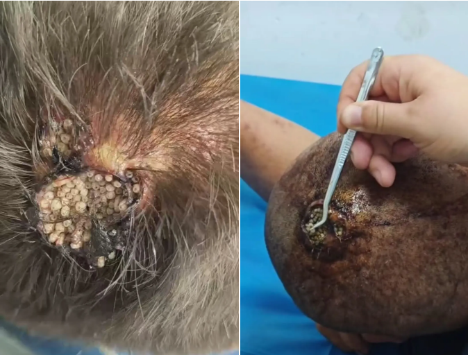 小伤口未处理竟致头顶长蛆？夏日警惕「蝇蛆病」