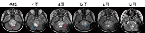 Nature 子刊丨张宏伟教授团队发表溶瘤病毒 Ad-TD-nsIL12 治疗儿童弥漫内生型桥脑胶质瘤 (DIPG) 的临床试验结果