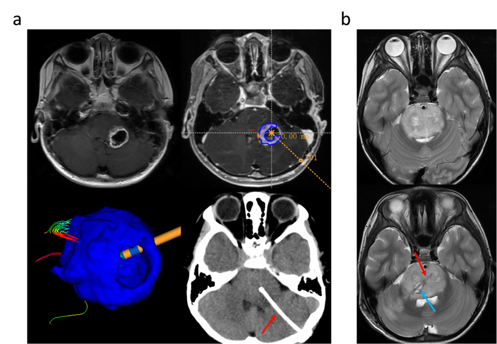 Nature 子刊丨张宏伟教授团队发表溶瘤病毒 Ad-TD-nsIL12 治疗儿童弥漫内生型桥脑胶质瘤 (DIPG) 的临床试验结果