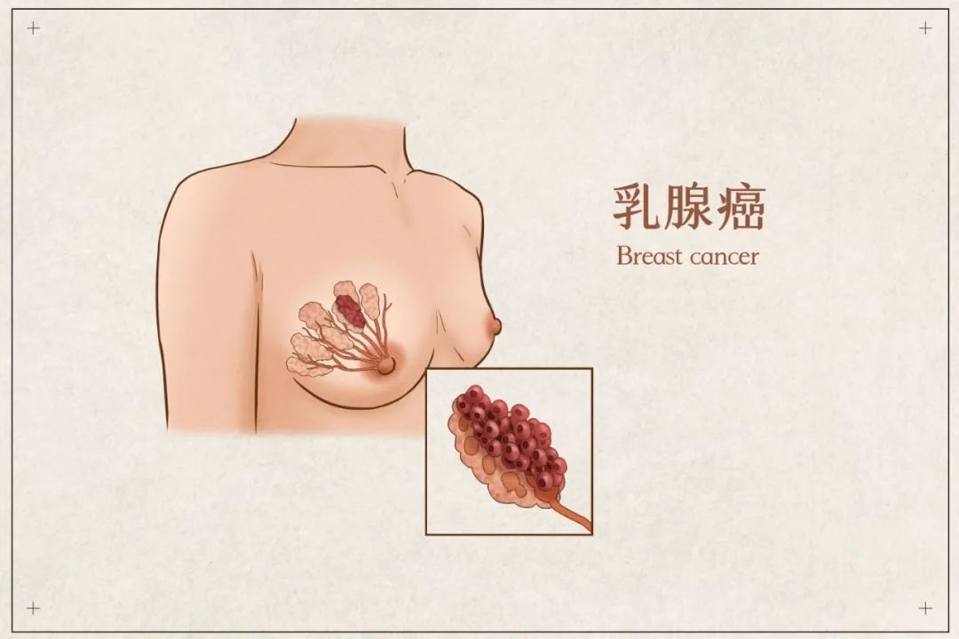 宫颈癌乳腺癌早期没症状，全靠筛查揪出来