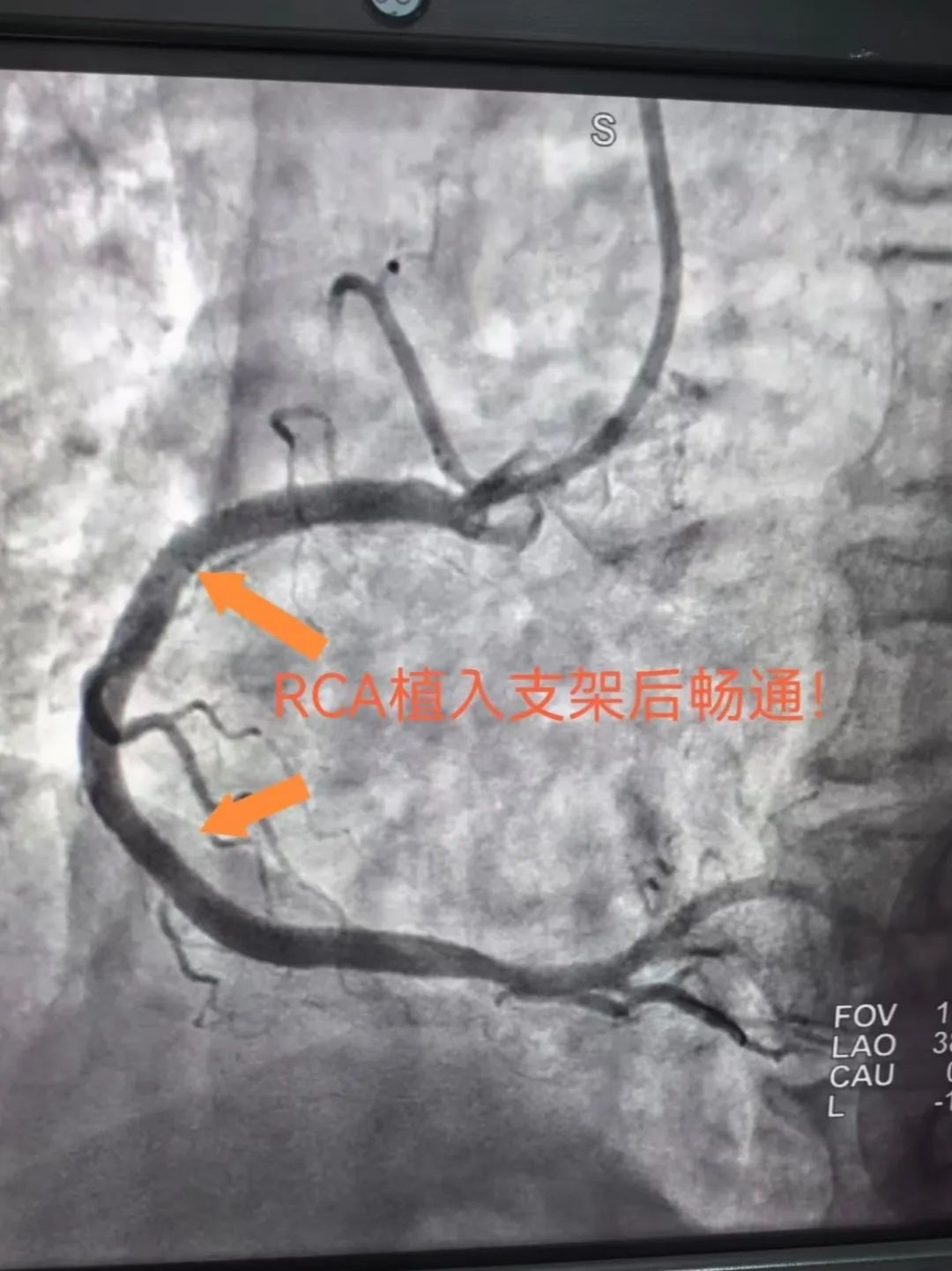 26 分钟极速开通血管！他们是如何做到的？