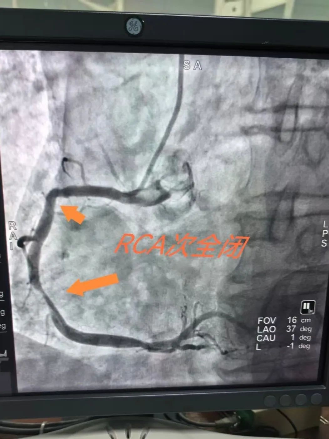 26 分钟极速开通血管！他们是如何做到的？