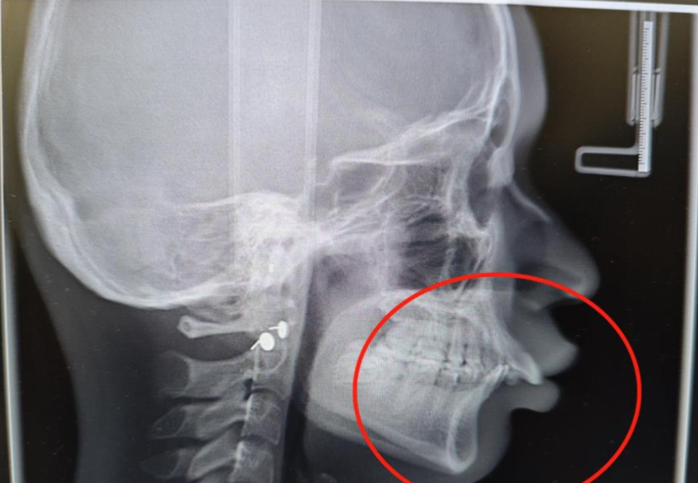 3 年定制 60 多副隐形牙套,助力 20 岁女孩告别「鸟嘴」